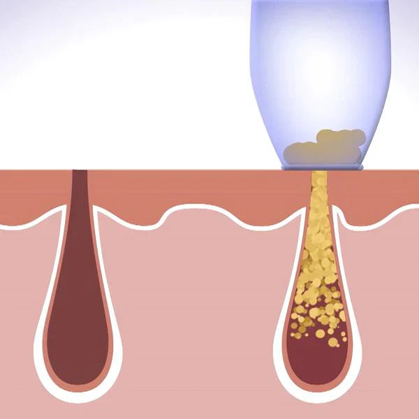 DERMASUCTION™ | PIMPLE & BLACKHEAD REMOVER